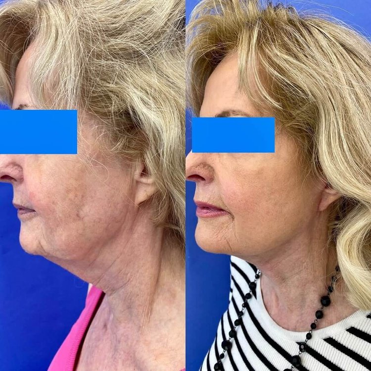 1 week post op mini face lift 40 years old