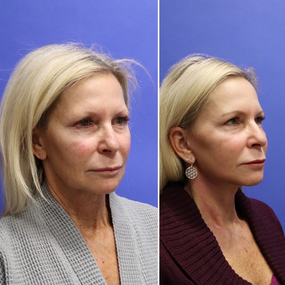 1 week post op mini face lift 40 years old